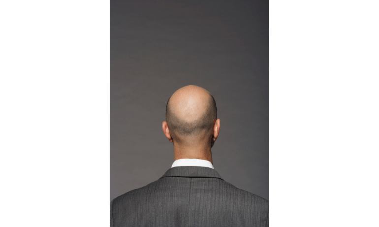 Employment tribunal: use of word ‘bald’ can amount to sex-based harassment